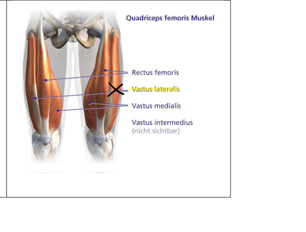 Vastus lateralis Platzierung markiert
